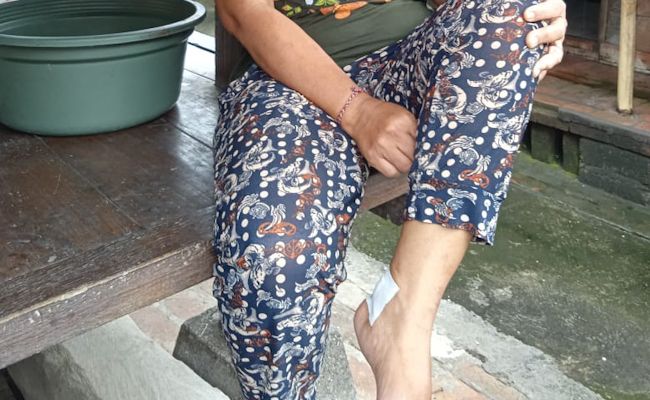 Bagian kaki Ni Ketut Kerti diperban setelah digigit anjing gila di Silungan, Lodtunduh, Gianyar. Bagian kaki Ni Ketut Kerti diperban setelah digigit anjing gila di Silungan, Lodtunduh, Gianyar.