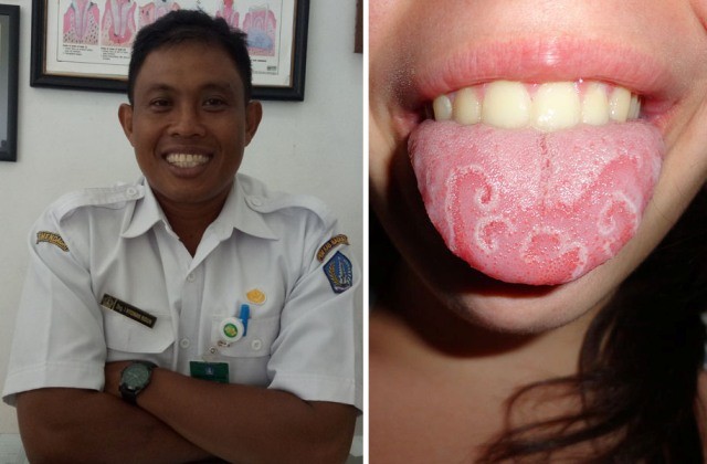 Geographic Tongue Penyakit Susah Sembuh Usia 20 Tahun Mulai Riskan
